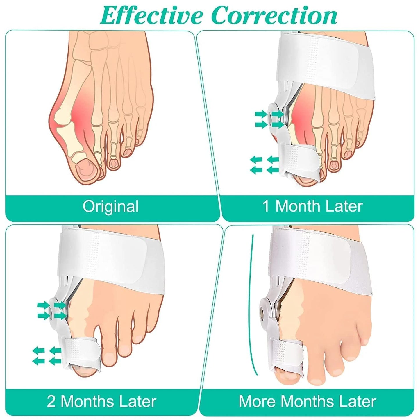 Comforta Ultimate Toe Aligner